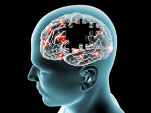 Neuroprothèse